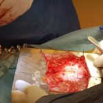 Reconstrucción Valvular Aórtica con tejidos propios del paciente | Preparación Pericardio Paciente para confeccionar nueva Válvula Aórtica | Cirugía Cardiovascular | Dr. Guillermo N. Vaccarino