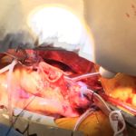 Reconstrucción Valvular Aórtica con tejidos propios del paciente | Reconstruccion Valvular realizada | Cirugía Cardiovascular | Dr. Guillermo N. Vaccarino