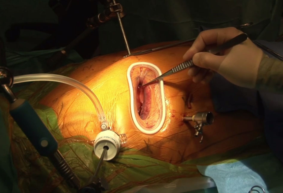 6 ventajas de la cirugía cardiovascular minimamente invasiva | Cirugía Cardiovascular | Dr. Guillermo Vaccarino