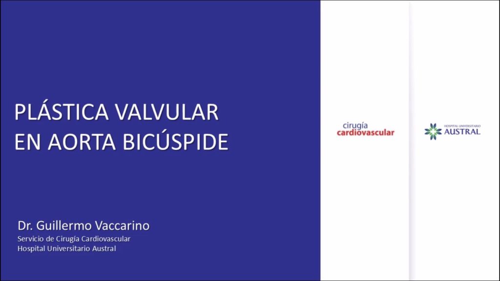Cirugía Plástica Valvular con Aorta Bicúspide | Cirugia Cardiovascular | Dr. Guillermo N. Vaccarino