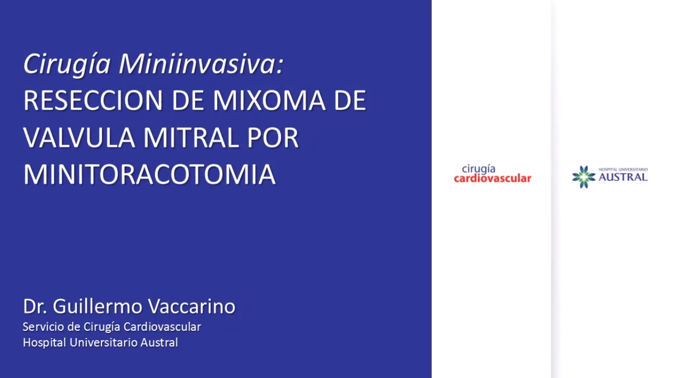 Cirugía Miniinvasiva: Resección de Mixoma de Válvula Mitral por Minitoracotomía