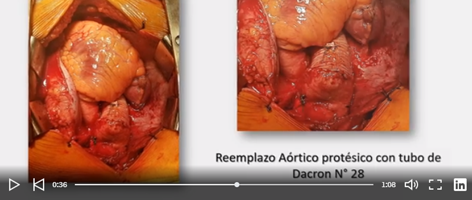 Reemplazo de Aorta ascendente | Cirugía Cardiovascular | Hospital Austral | Dr. Guillermo Vaccarino