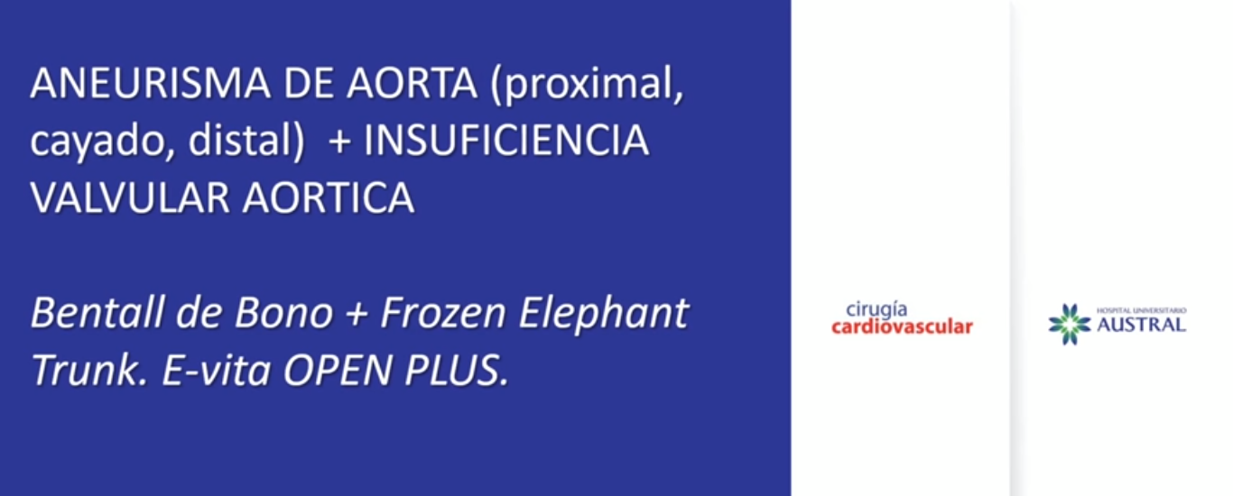 ANEURISMA DE AORTA (proximal, cayado, distal) + INSUFICIENCIA VALVULAR AÓRTICA