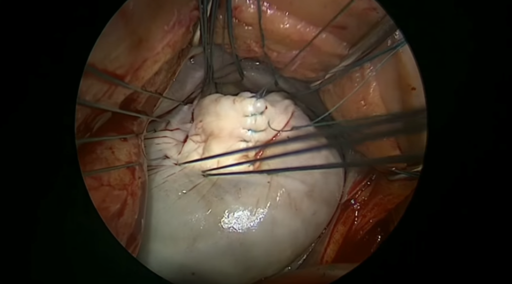 Plastica Mitral Compleja | Cirugia Cardiovascular