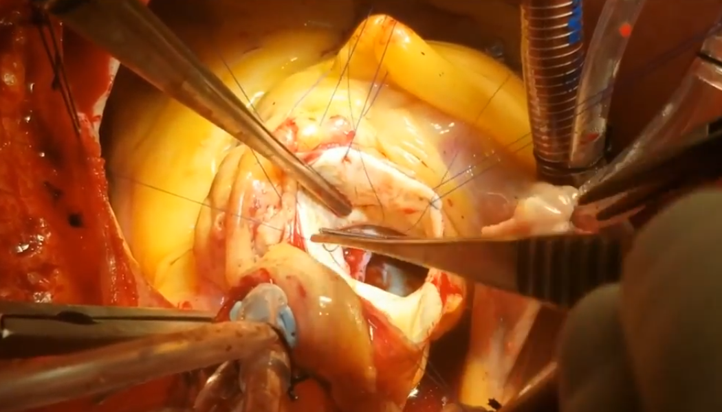 ENDOCARDITIS VALVULAR AORTICA + ABSCESO PERI ANULAR