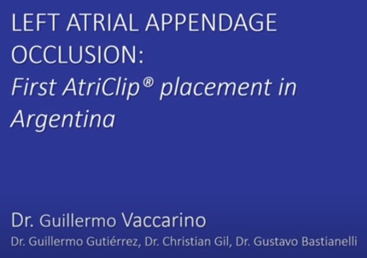 Exclusión de Orejuela Izquierda. Primera colocación de Sistema Oclusor en Argentina